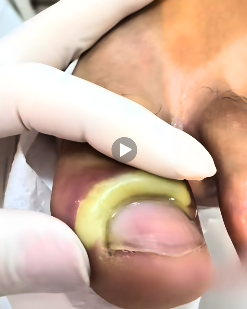 Pain After Cutting Nails