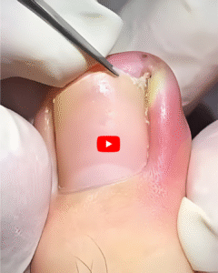 Can Tight Socks Cause Nail Fungus Understanding the Connection and How to Prevent It