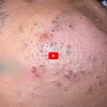 How to Prevent Acne Naturally: Complete Guide for Clear and Healthy