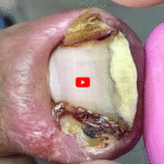 Why Nails Break Easily: Causes, Effects, and Care Tips