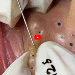 Understanding Face Acne and Effective Health Tips to Prevent It