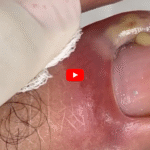 Why Does Nail Fungus Occur? Causes, Symptoms, and Prevention