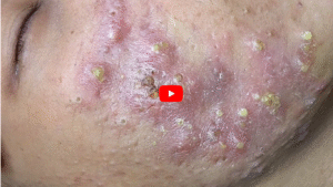 Does Creatine Cause Acne