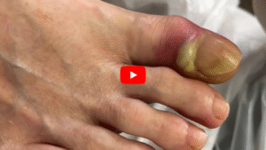 Will a Damaged Nail Bed Grow Back? Causes, Healing Process & Treatment Guide