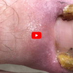 How to Treat Toenail Fungus at Home (Safe Options)