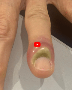 How to Treat an Infected Ingrown Toenail