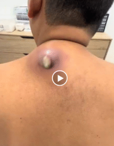 How to Treat Dry Lips Naturally at Home