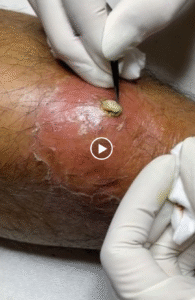 How to Treat a Pimple Under the Skin: Effective and Safe Methods