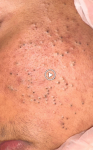 Acne and the Best Skincare Routines: A Complete Guide