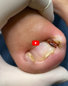 8 Effective Ways to Remove or Treat an Ingrown Toenail