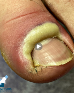 How to Treat a Fungal Nail Infection at Home