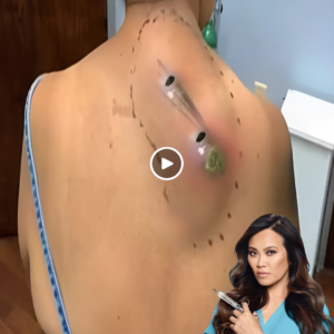 How Back Cysts Are Treated: A Complete Guide