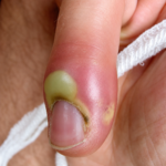 10 Effective Techniques to Clean an Ingrown Nail at Home