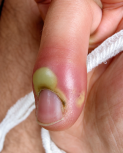 10 Effective Techniques to Clean an Ingrown Nail at Home