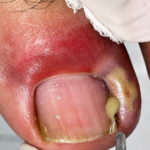 Why Do Nails Swell During Winter? Causes, Prevention, and Natural Care Tips