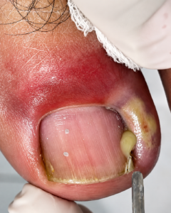 Why Do Nails Swell During Winter? Causes, Prevention, and Natural Care Tips
