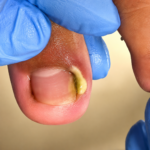 Nail Swelling in Cold Weather: Causes, Symptoms, and Home Treatment