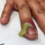Nail Corner Fiber or Debris: Causes, Home Treatment, and Nail Care Tips