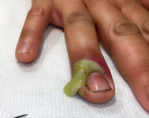 Nail Corner Fiber or Debris: Causes, Home Treatment, and Nail Care Tips