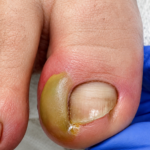 The Painful Reality of an Infected Ingrown Toenail
