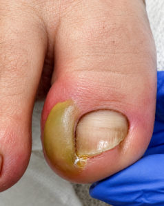 The Painful Reality of an Infected Ingrown Toenail