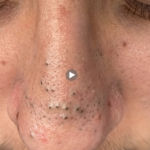 Nose Acne in 2026: Why You Keep Getting Pimples on Your Nose (And How to Finally Stop Them)