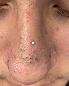 Nose Acne in 2026: Why You Keep Getting Pimples on Your Nose (And How to Finally Stop Them)