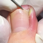 Yellow Fiber-Like Growth on the Corner of the Nail: Causes, Treatment, and Prevention