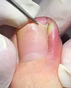 Yellow Fiber-Like Growth on the Corner of the Nail: Causes, Treatment, and Prevention