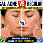 Fungal Acne vs Regular Acne: How to Tell the Difference and Treat Both Effectively