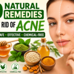 10 Natural Remedies to Get Rid of Acne Naturally: Safe and Effective Home Treatments