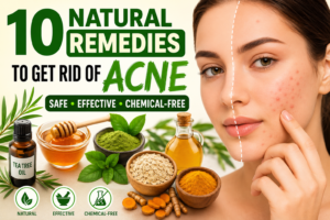 10 Natural Remedies to Get Rid of Acne Naturally: Safe and Effective Home Treatments
