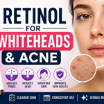 9 Best Retinol and Retinoid Options for Whiteheads & Acne