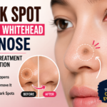 Dark Spot After Whitehead on Nose: Causes, Treatment & Prevention
