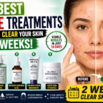 5 Best Acne Treatments That Can Help Clear Your Skin in 2 Weeks