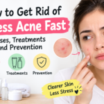 How to Get Rid of Stress Acne Fast: Causes, Treatments & Prevention