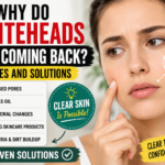 Why Do Whiteheads Keep Coming Back? Causes, Prevention & Best Solutions