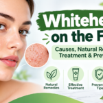 Whiteheads on the Face: Causes, Treatment, Natural Remedies & Prevention