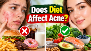 Does Diet Affect Acne? Best and Worst Foods for Clear Skin