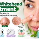 Nose Whitehead Treatment: Causes, Best Products, Removal & Prevention